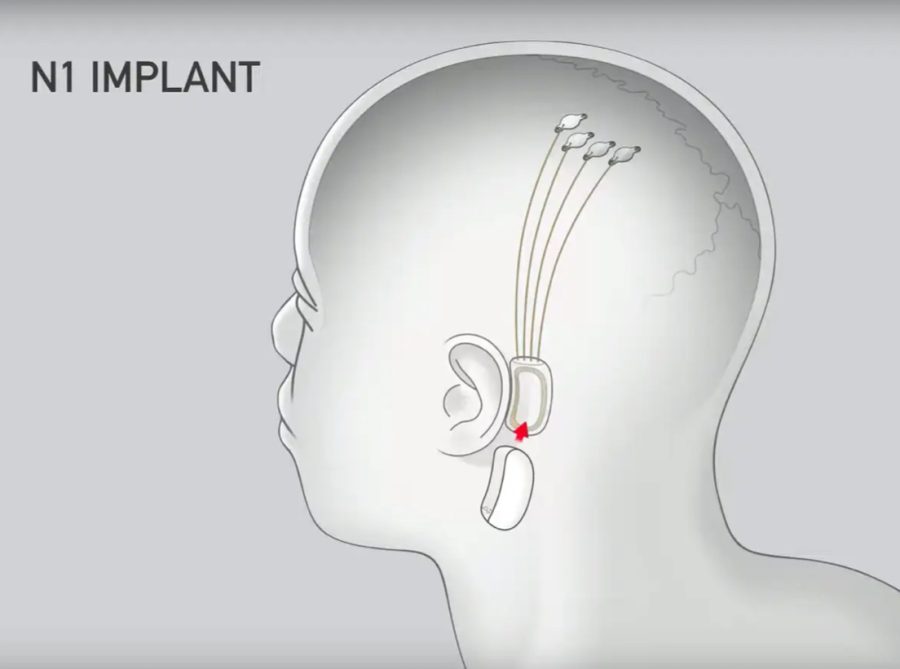 The chip sits behind the ear, while electrodes are threaded into the brain.